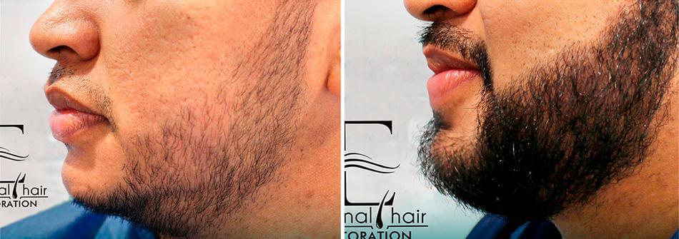 Before and After treatment