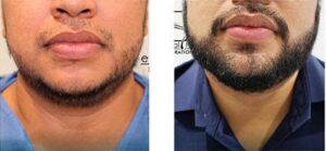 Before and After treatment