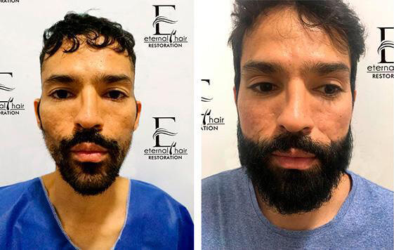 Before and After treatment