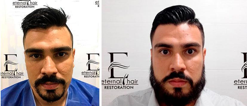 Before and After treatment