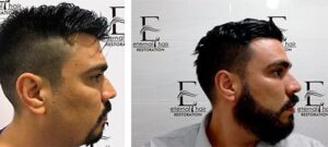 Before and After treatment