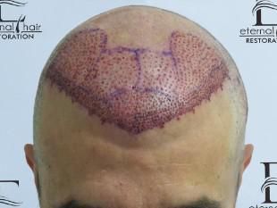 1st day of procedure