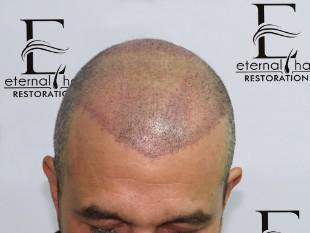 6th day of procedure