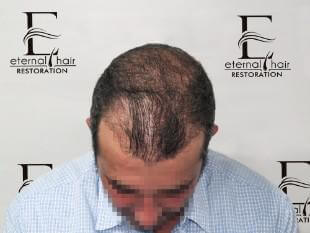 3 month of procedure