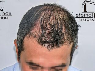 4th month of procedure