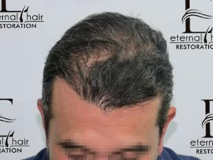 7th month of procedure