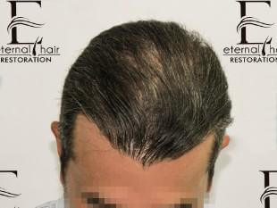 8th month of procedure