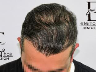 10th month of procedure