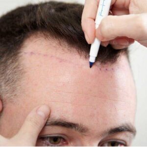 Step by step hair transplant