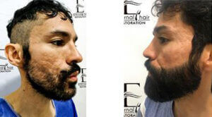 Before and After treatment